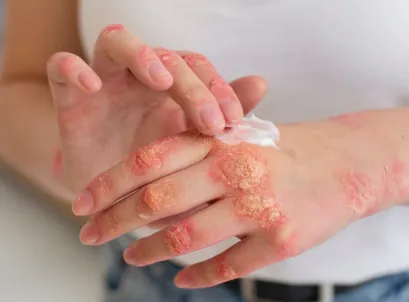 Hands with visible skin rashes and irritation, illustrating skin related disorders
