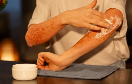 Leaky gut and psoriasis connection